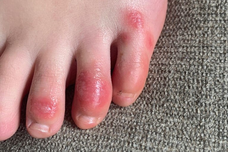 Chilblains
